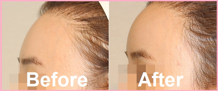 7 24 forehead fatgrafting jade plastic surgery seoul korea